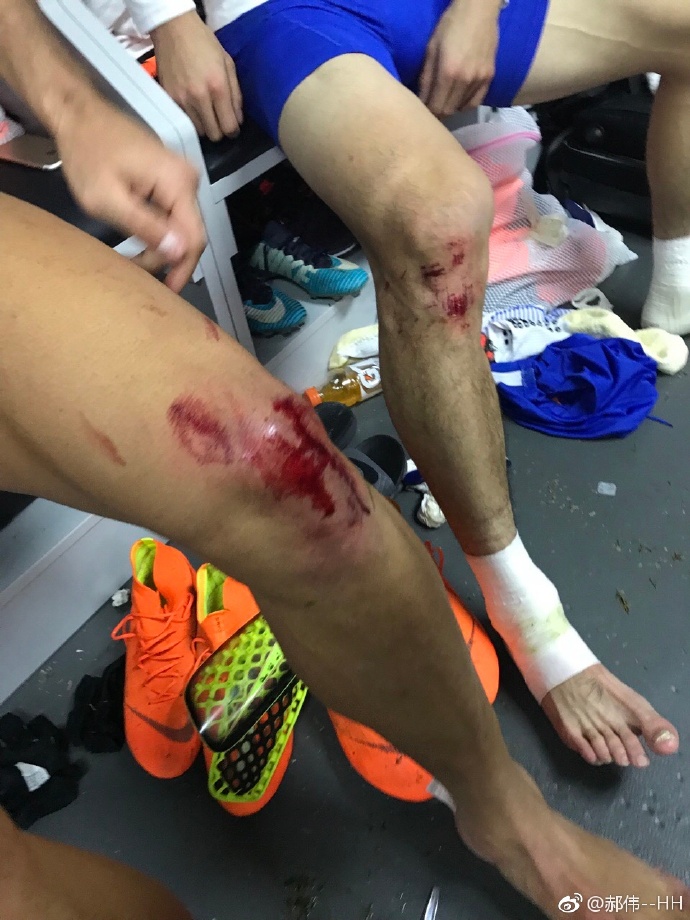 看着都疼!郝伟晒出鲁能两将受伤图,膝盖位置鲜血淋漓