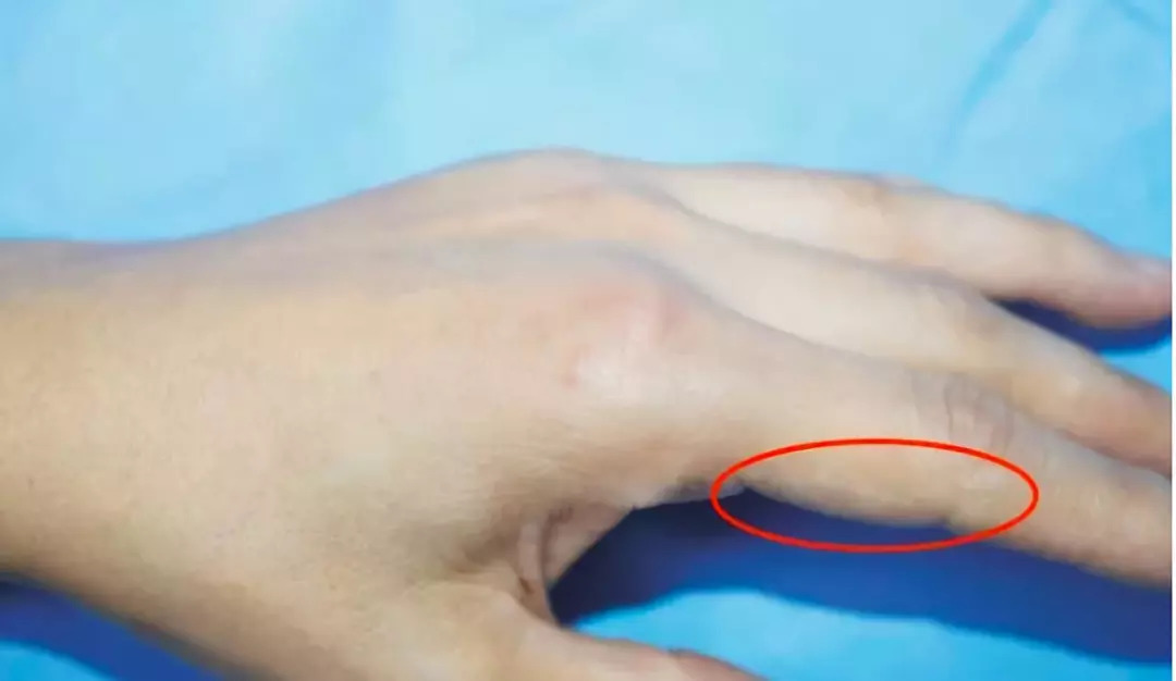 ▼左食指第二掌指关节桡侧疼痛医生发现,患者左手手指有肉芽组织,检验