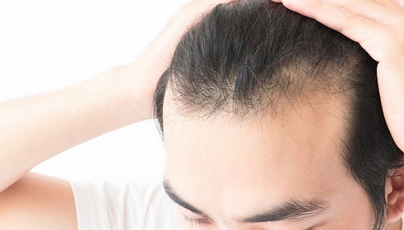 3 15特别报道 一个香港男人决定去科发源植发 植发 新浪财经 新浪网