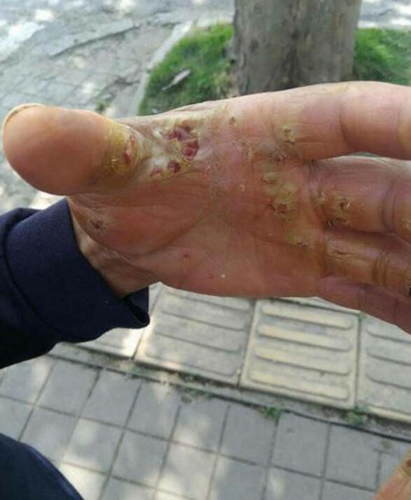 成都两环卫工双手被强酸腐蚀