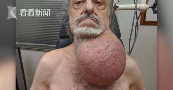 肿瘤|手术_新浪新闻