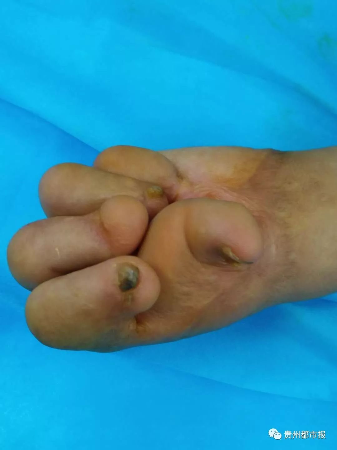 没想到,过段时间打开纱布时,才发现弟弟的五根手指全部粘连在了一