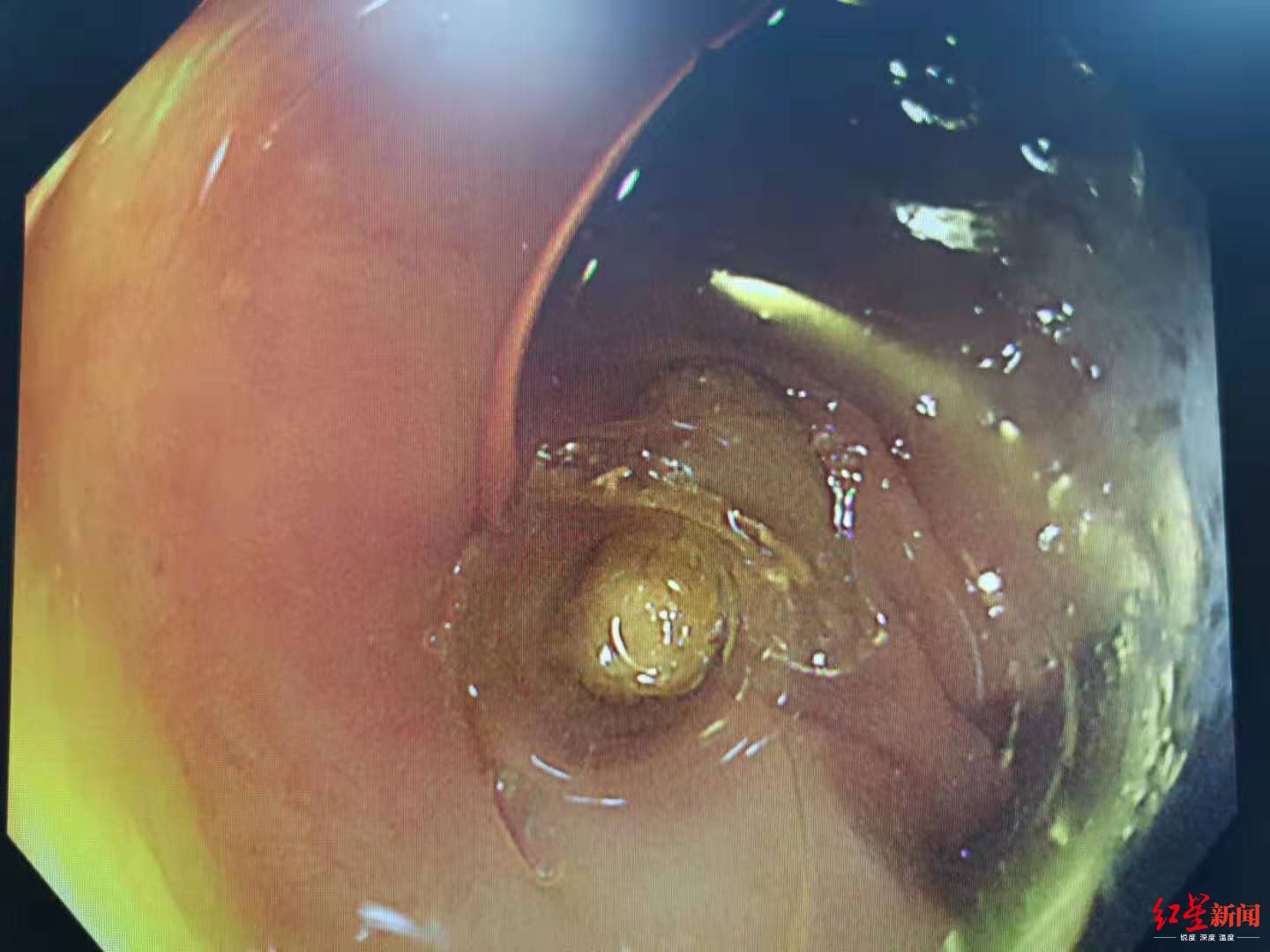 急性阑尾炎必须要切除阑尾吗