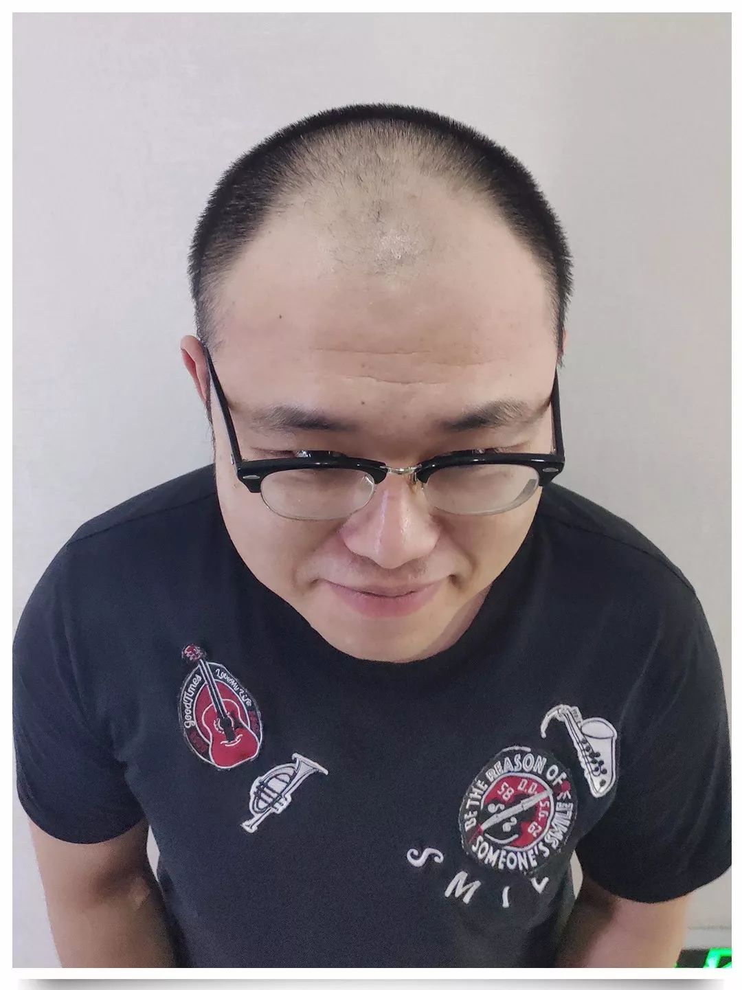 黑龙江秃顶大叔只有31岁,一个选择让他重回"颜值巅峰"!脱发的你赶快了