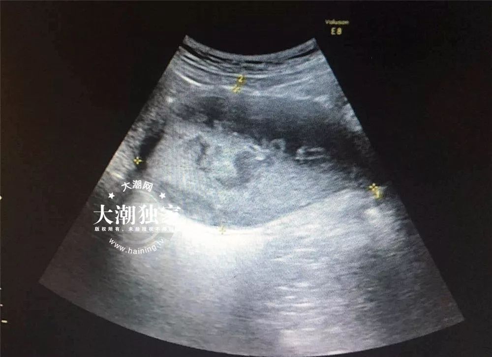 当场就觉得小燕的情况有些特别,于是马上给小燕安排了b超和妇科检查