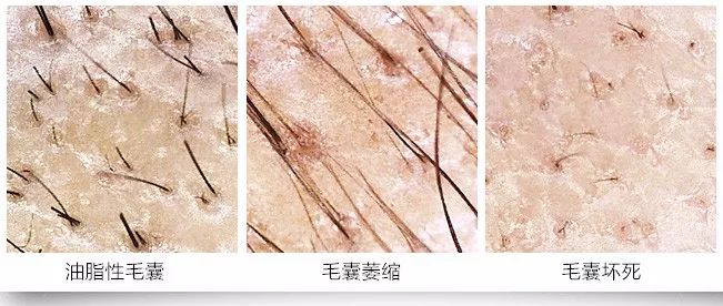 免费毛囊检测,脱发等级鉴定