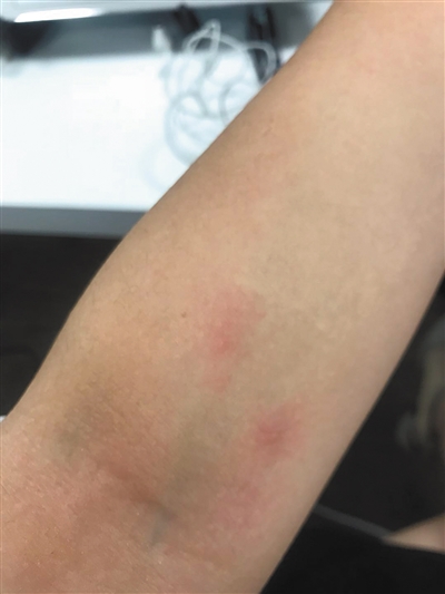 姚某称在居住期间皮肤出现过敏红肿.受访者供图
