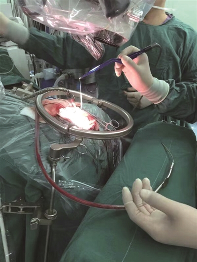 惊13岁男孩脑中取出15厘米长活虫