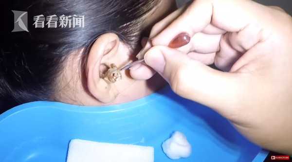 太酸爽女子25年没掏耳屎医生挖出2坨巨无霸