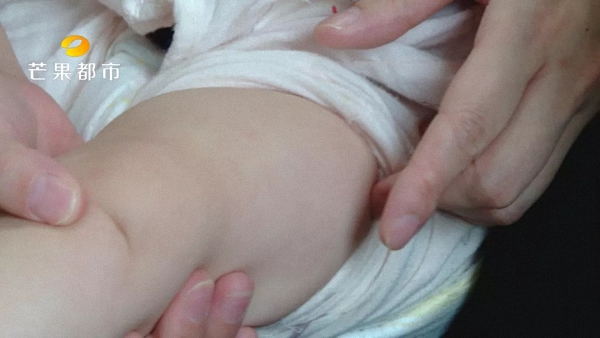 婴儿大腿外侧肌肉注射图片