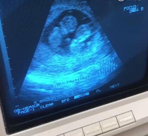 刘承俊晒b超视频宣布二胎喜讯双胞胎