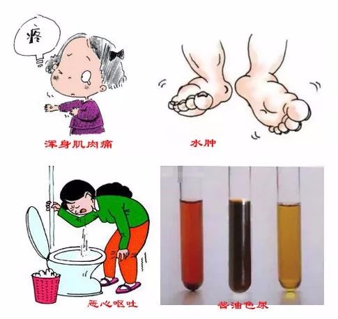 橫紋肌溶解除了小龍蝦還有這原因許多人都沒注意到