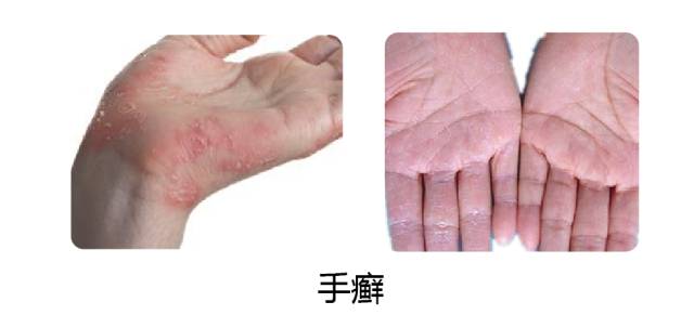 汗疱疹|手癣|水泡_新浪新闻