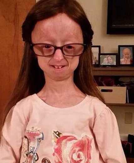 相信大家也可以看出戴琳患得这种疾病了吧,她患的是一种早衰症.