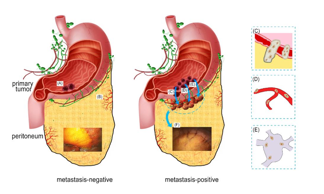 自动化所等在胃癌隐匿性腹膜转移智能诊断研究中获进展