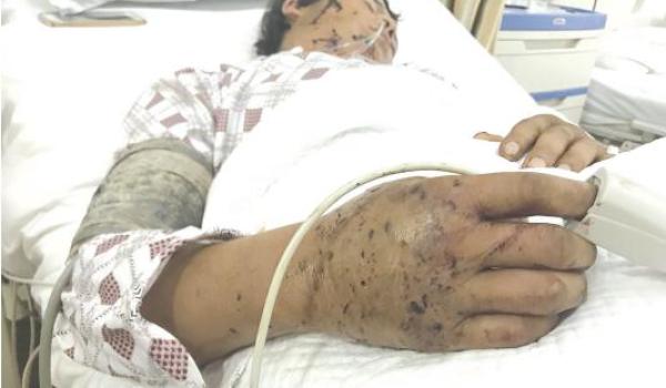 张永康被抓:男子下班路上被蜂蜇伤40多处 多脏器衰竭命悬一线 病床上的张永康,手肿胀得比馒头还大。贵州都市报 图