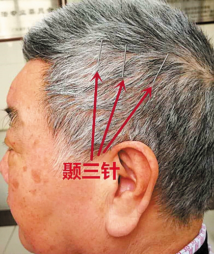 试试"靳三针" 颞三针的位置  文/图 羊城晚报记者 陈辉 通讯员 张秋霞
