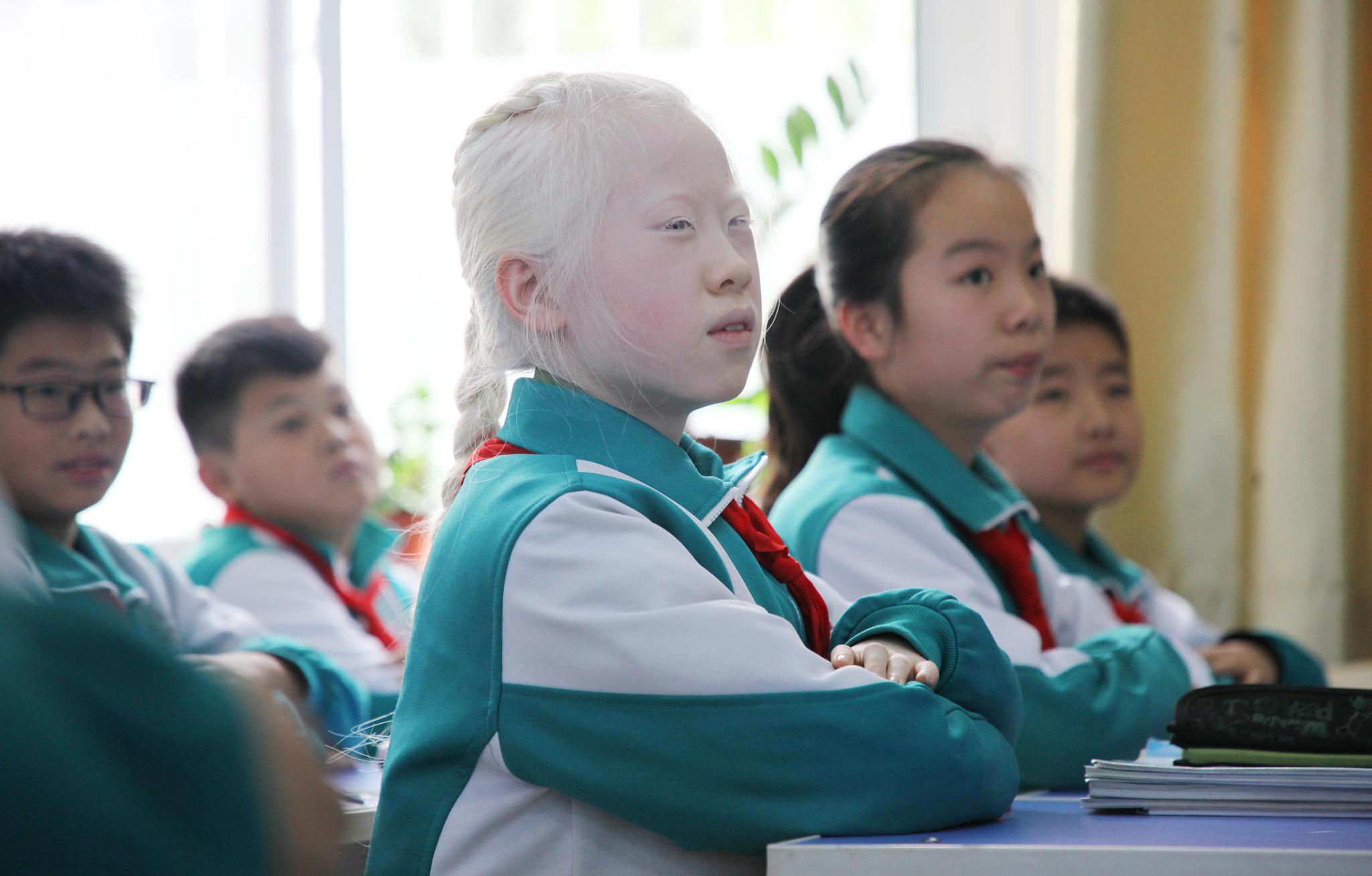 11岁白化病女孩视力仅004同学争当她的眼睛