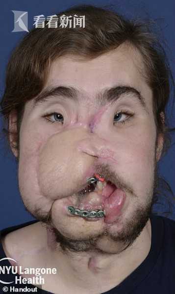 男子失恋拔枪轰烂自己脸 25小时换脸手术获重生