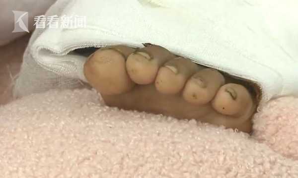 六岁女童坐摩托 脚后跟惨被车轮绞断