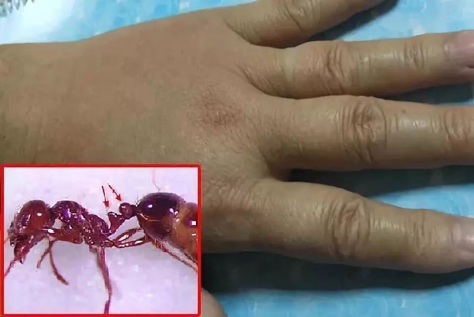 今后看到这种小虫请不要碰已有人被咬身亡中山也有