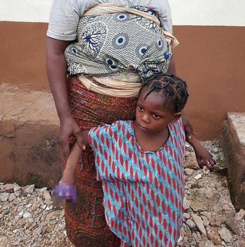 残忍!非洲女童肚饿偷吃泡面,遭狠心奶奶把她手放煤气炉上烤焦!