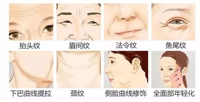 解决面部衰老您应该试试ppdo线雕提拉