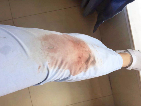 跪在碎玻璃上挽救生命 江津区中医院护士"火了"朋友圈