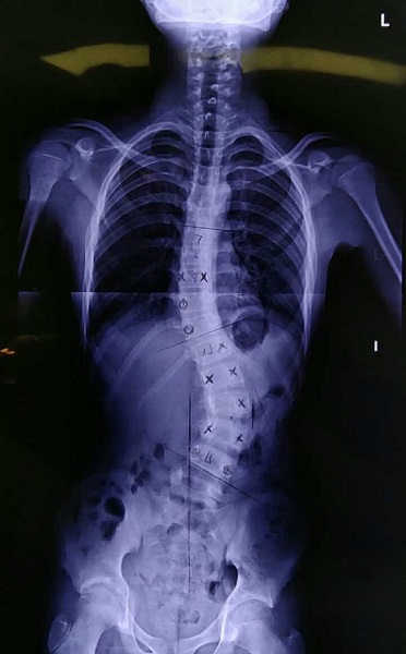 全国脊柱侧弯患者超300万新华医院着力打造防控与治疗干预体系