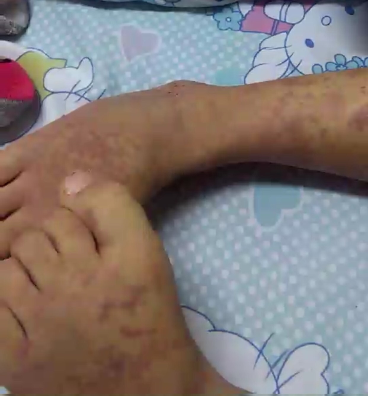 别名儿童被确诊为过敏性紫癜仍在批准治疗。 受访者供图
