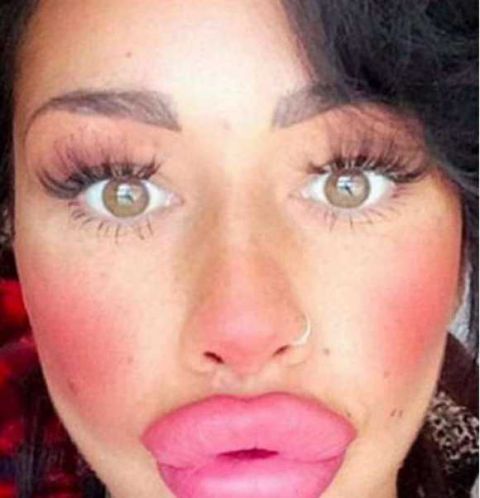 女子整容成瘾,花费1.7万将嘴唇整容成"香肠嘴",丑哭路人!