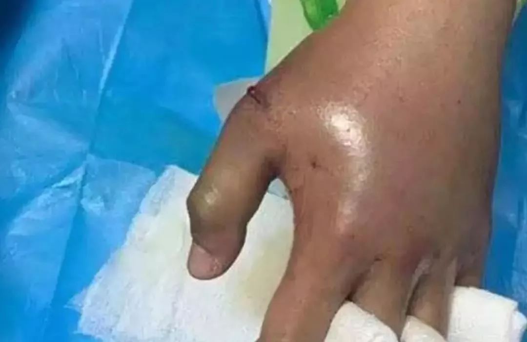 还有更严重的,2018年,陕西渭南21岁女孩网购银环蛇,被咬伤左手食指后