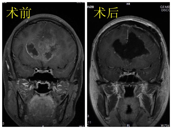 神经外科专家采用单侧额叶入路为患者摘除双侧额叶侵及胼胝体巨大肿瘤