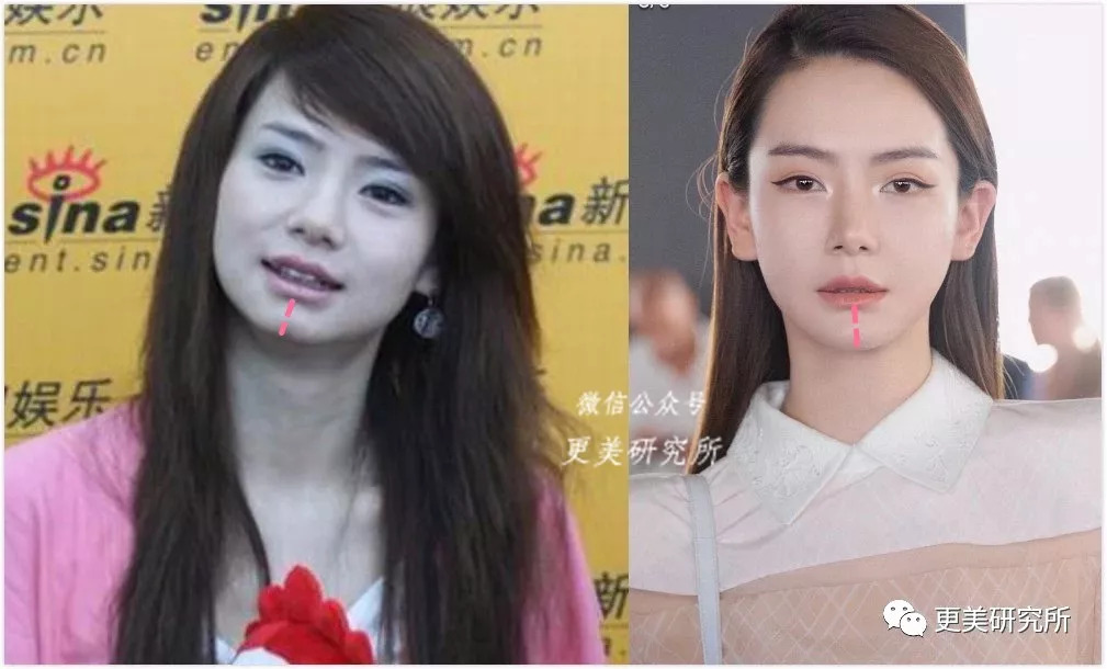 为啥23岁的她动了一次就成了鞋拔子脸