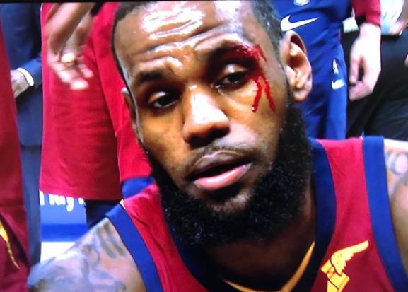 眉骨受伤!詹皇喋血赛场 奈何被打崩三节提前下班