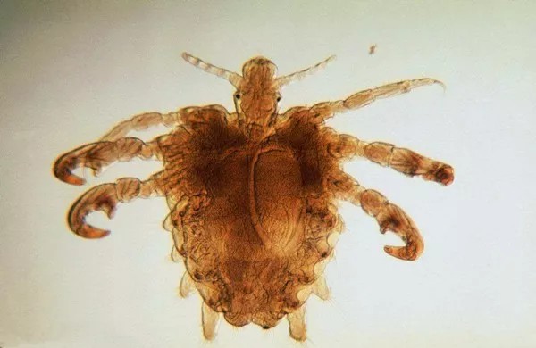 她眼睫毛上竟住着这么多虫子|桐乡|阴虱|虫子_新浪新闻