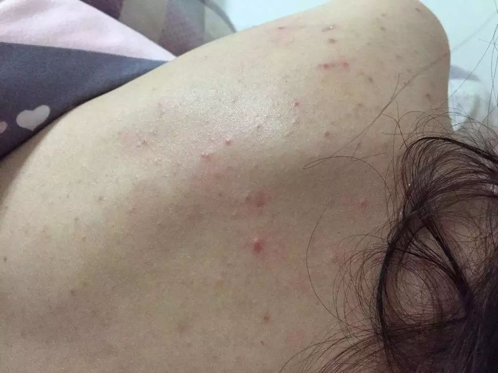 浴室里备一块儿,还没用完痘痘就好了,轻松拥有光滑美背!