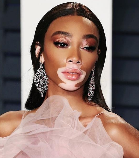 白癜风模特Winnie Harlow