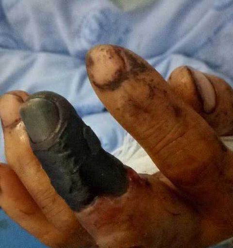 男子遭五步蛇咬险丧命 竟是一通电话惹的祸