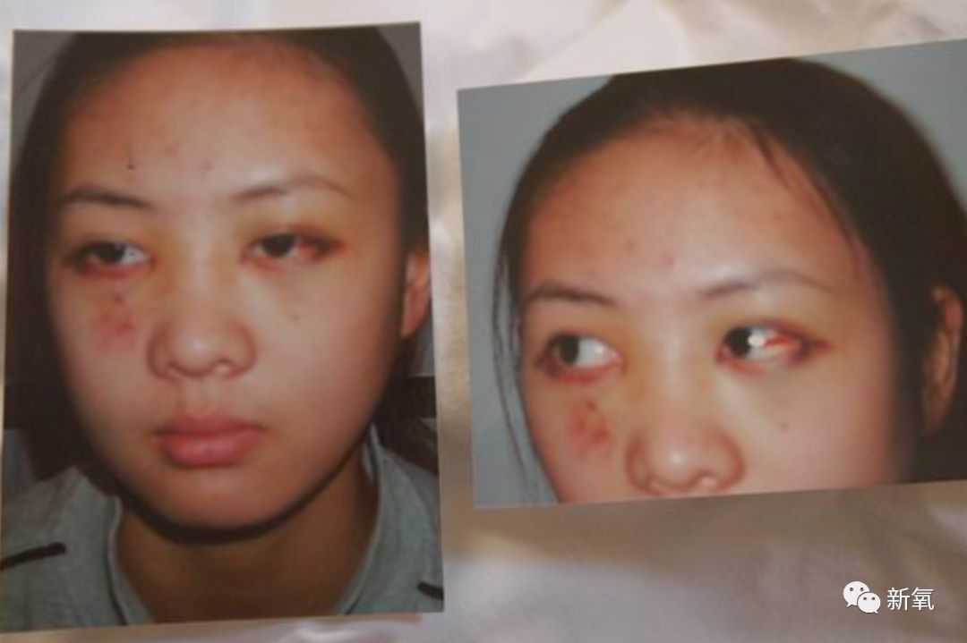 童瑶挨打后的照片