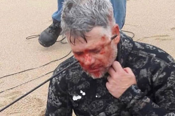 南非一男子海中潜水时不幸用捕鱼枪射穿自己头部