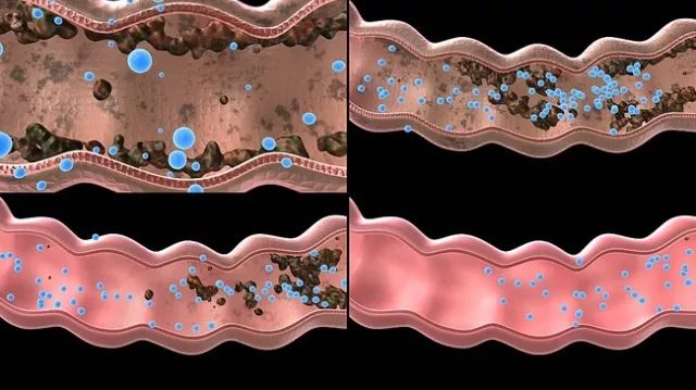 想要瘦,肠先动!肠道内积存了6.5kg的垃圾,你不胖谁胖.