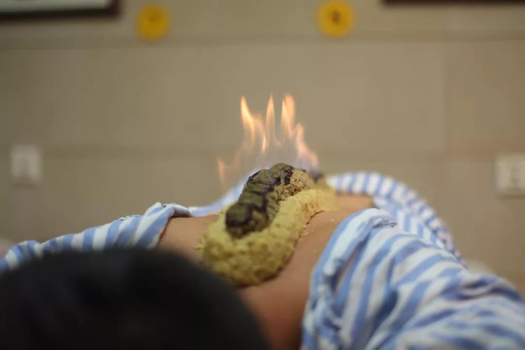 4.直接灸 艾炷直接放在穴位皮肤上施灸. 5.