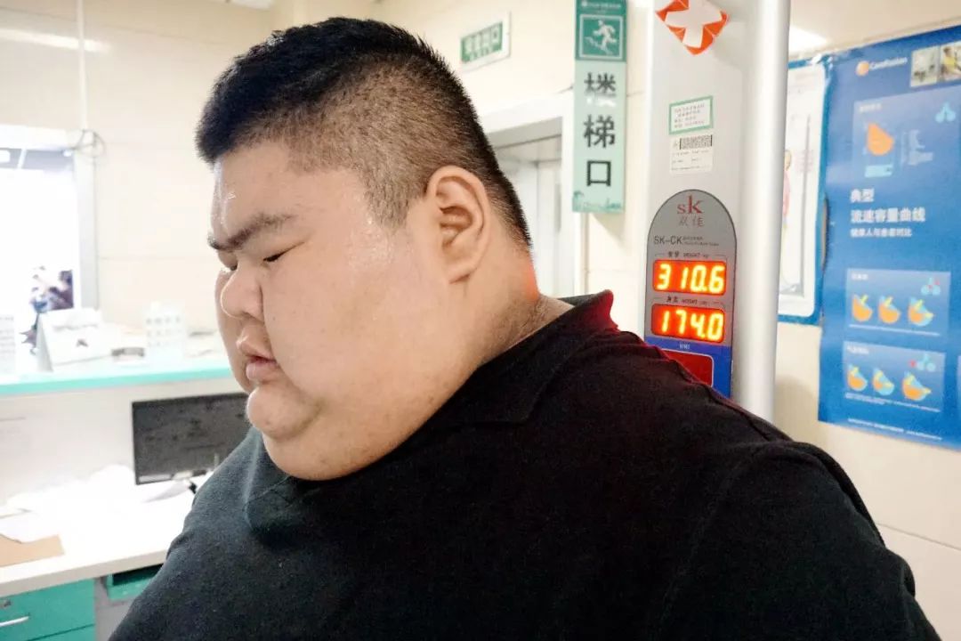 腰围2米2,体重668斤的中国"首胖"——莱芜小伙减肥成功!