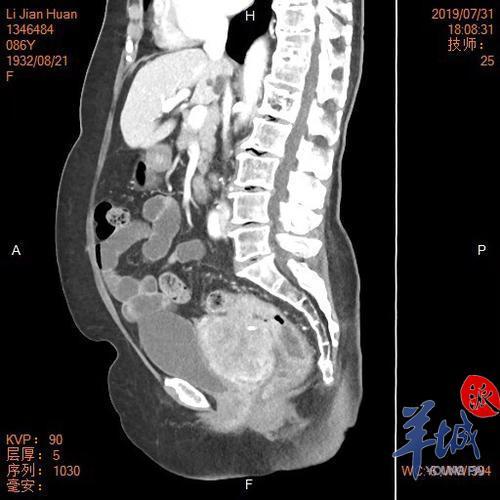 87岁阿婆长菠萝大小肿瘤,医生没“开刀”就完整取出?