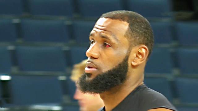 詹姆斯被格林戳中的眼睛充血严重,帕金斯看了