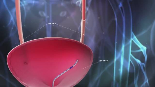 双j管置入术_手机新浪网
