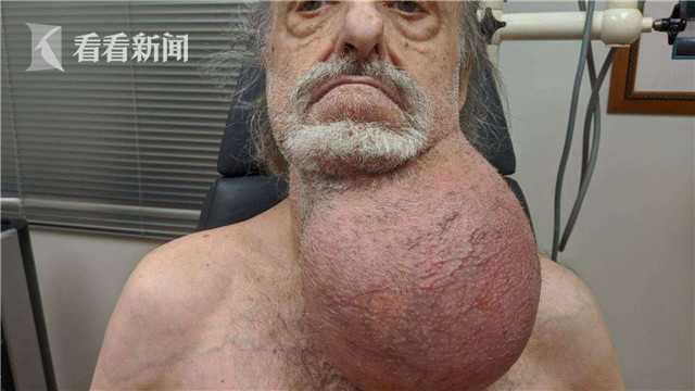 81岁男子下巴长一足球大小肿瘤 医生不敢切除