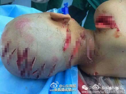 河南5岁男孩被继母砍30多刀!(组图)