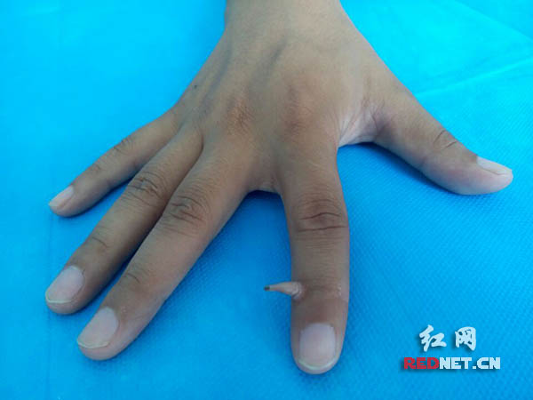 (湘潭男子李煜(化名)右手食指上的"皮角")红网长沙